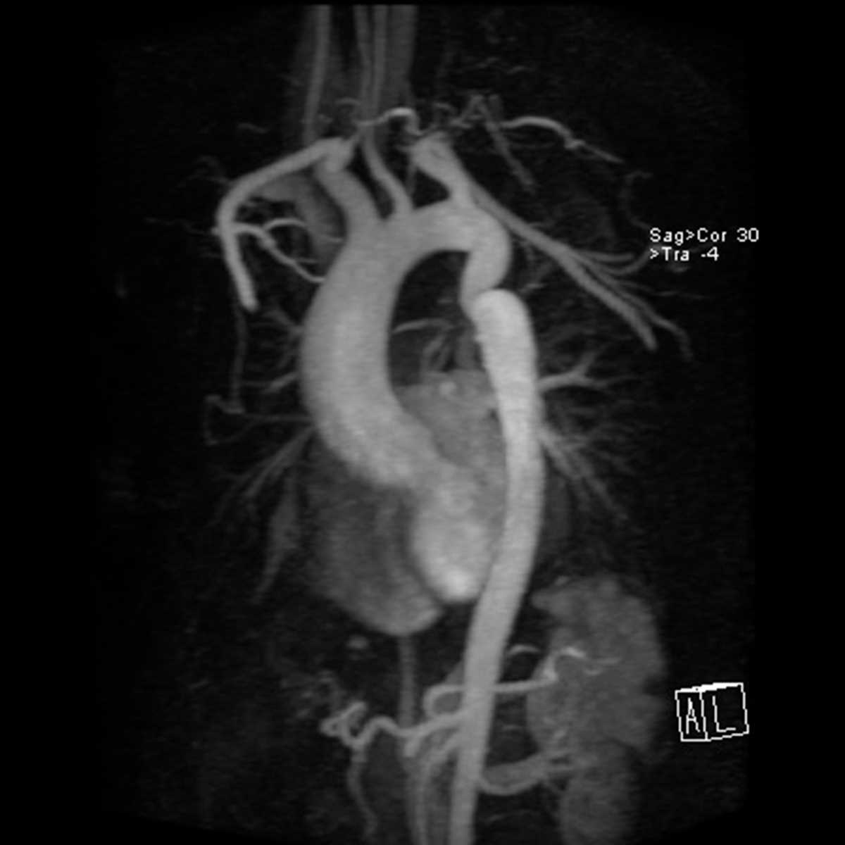 Aortic Coarctation - CTisus CT Scan