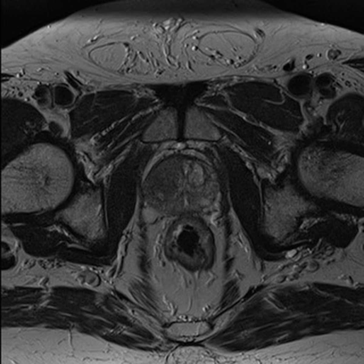 Prostate Cancer - CTisus CT Scan