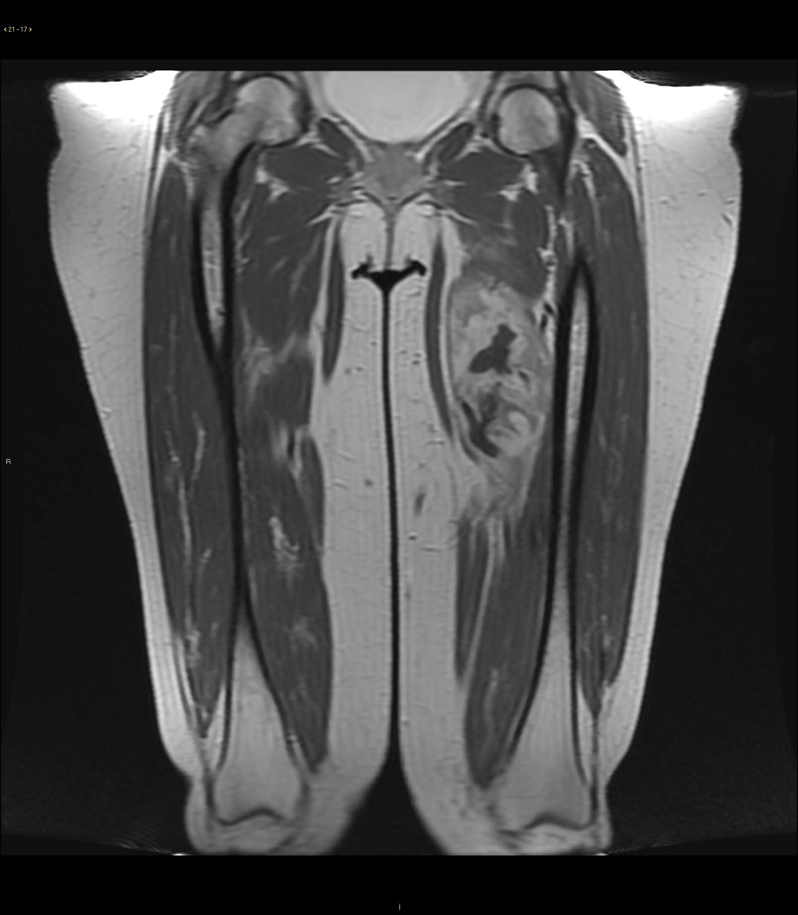 Myxofibrosarcoma grade 3 - CTisus CT Scan
