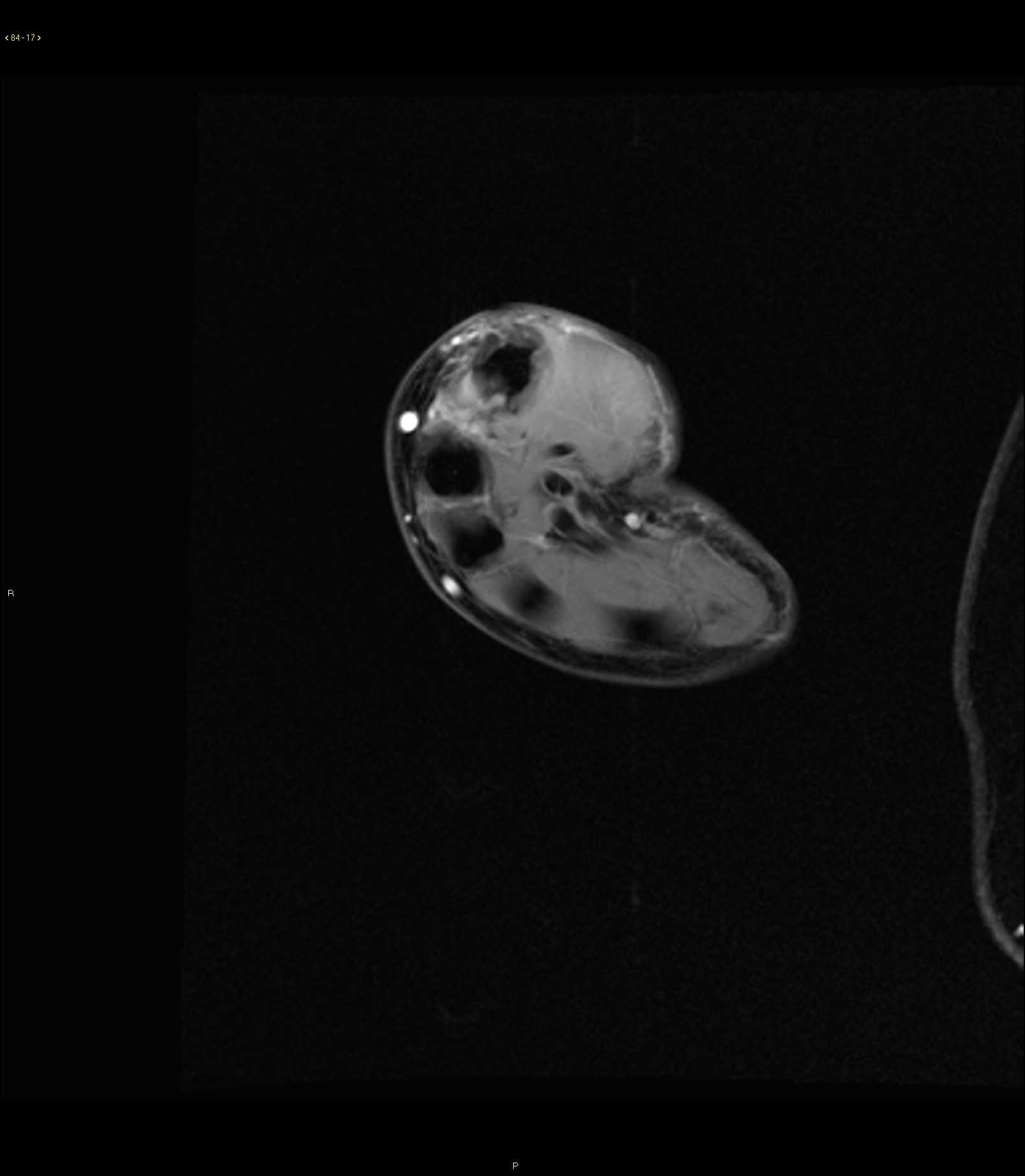 Maffucci Syndrome - CTisus CT Scan