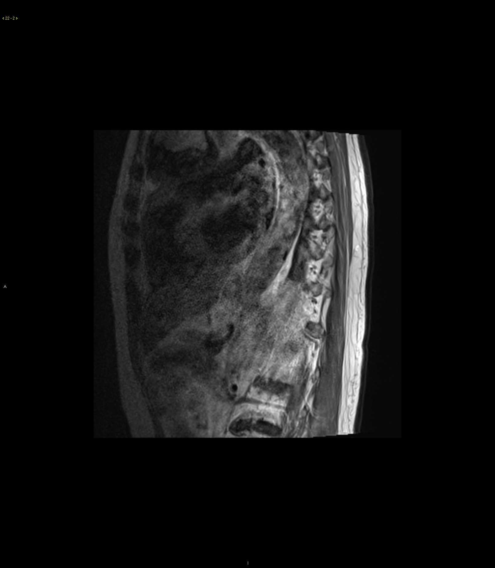 Malignant Mediastinal Teratoma - CTisus CT Scan