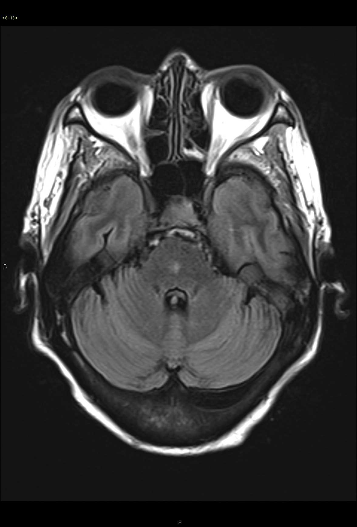 Persistent Trigeminal Artery - CTisus CT Scan