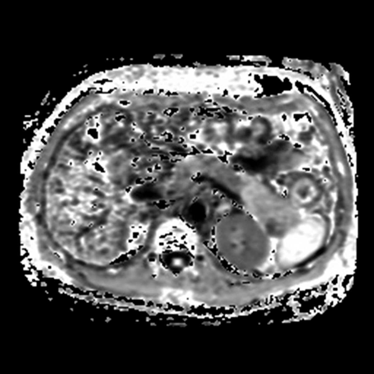Pancreatic cancer - CTisus CT Scan