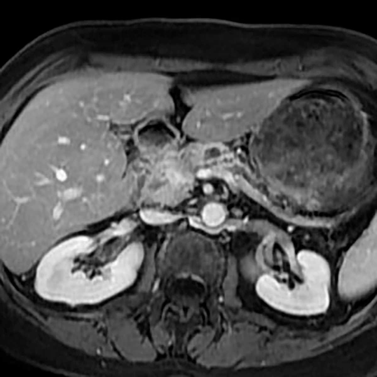 Pancreatic adenocarcinoma - CTisus CT Scan