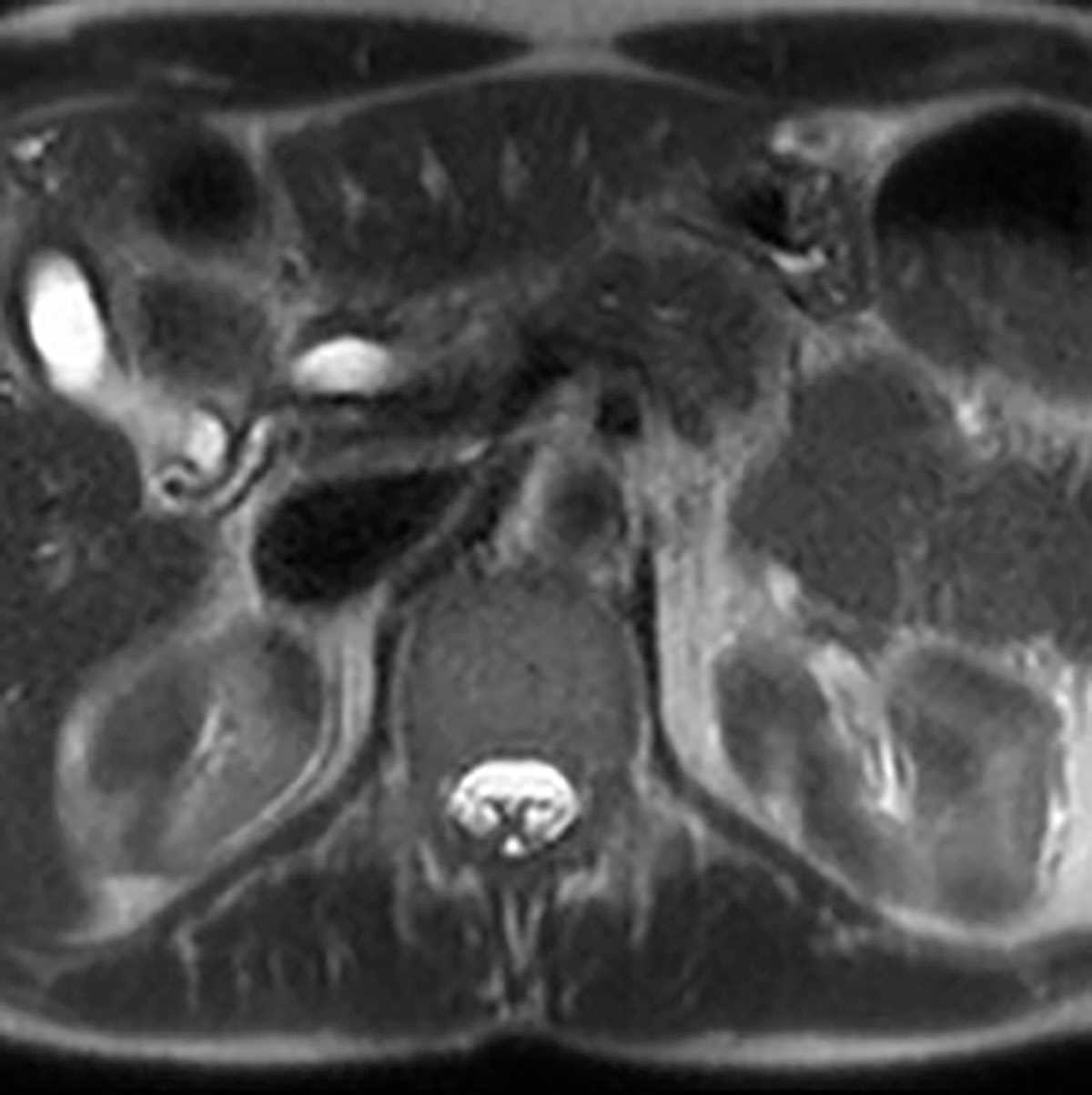 Autoimmune pancreatitis - CTisus CT Scan