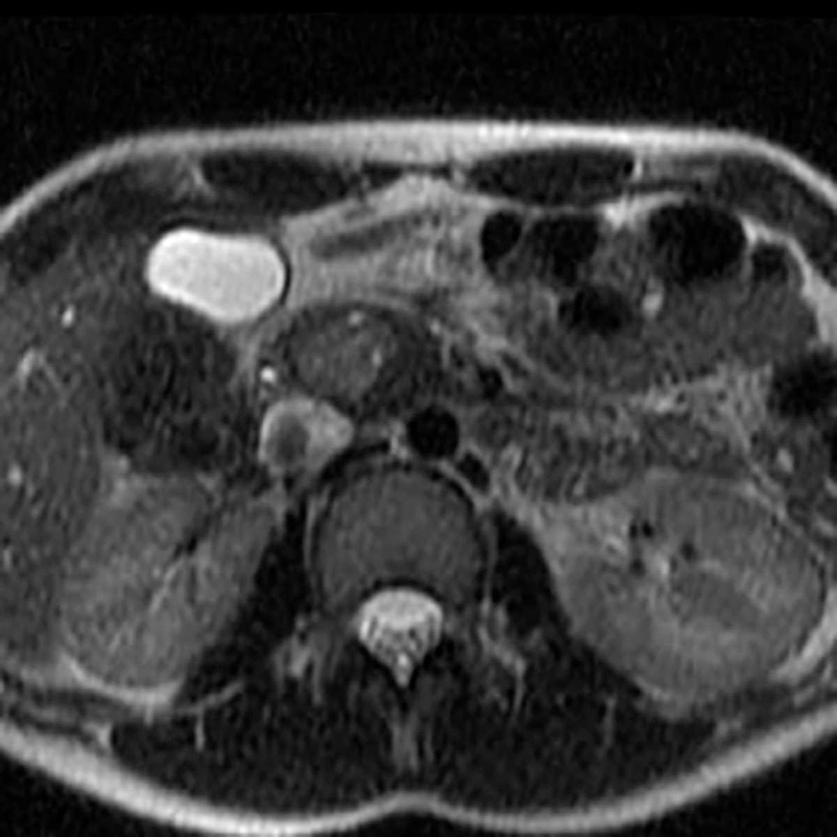 Solid pseudopapillary tumor - CTisus CT Scan
