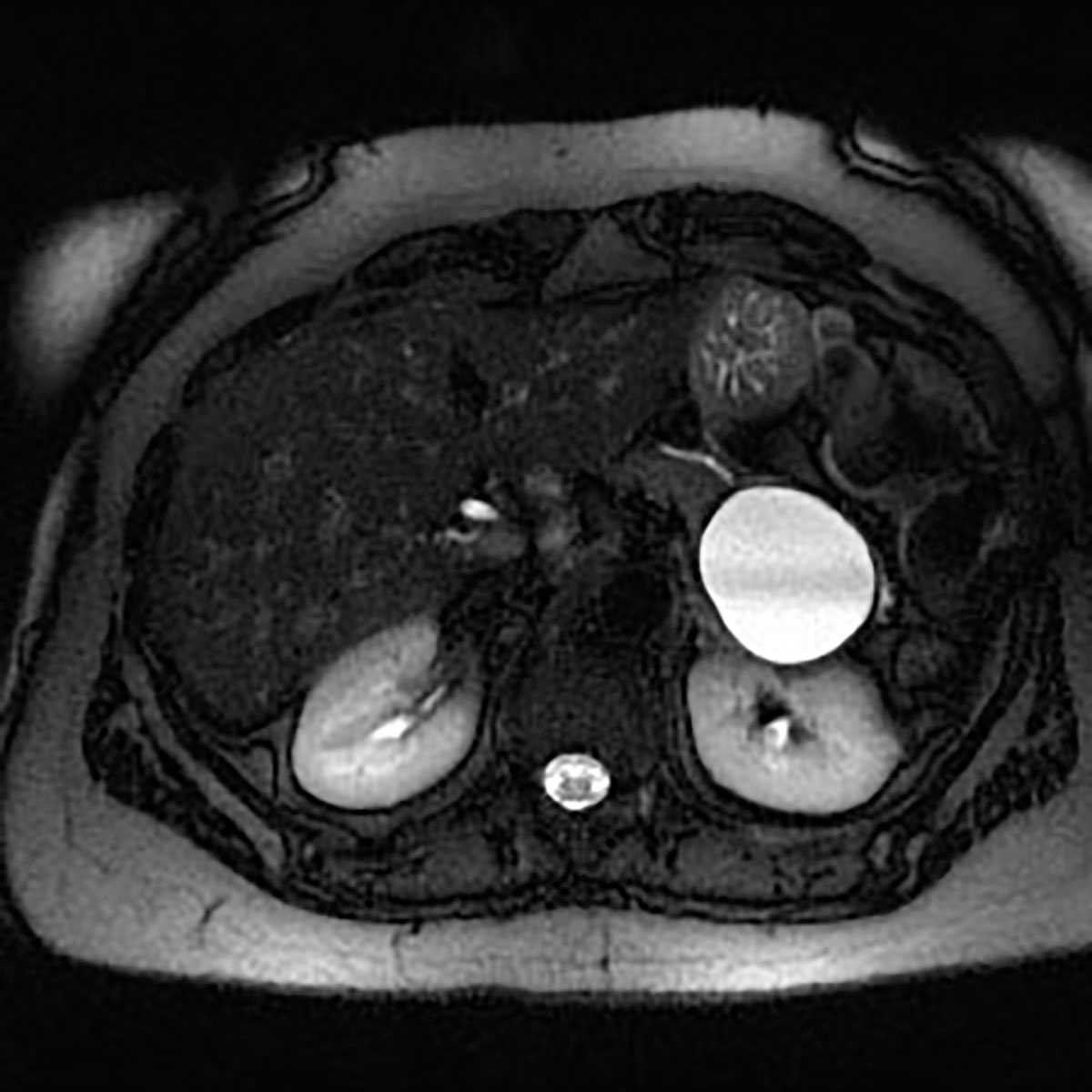 Mucinous cystic neoplasm (MCN) - CTisus CT Scan