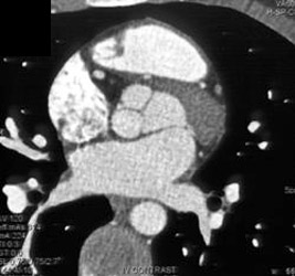 Aortic Valve - CTisus CT Scan