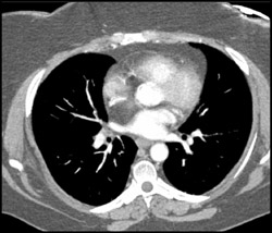 Lipoma in Right Atrium - CTisus CT Scan