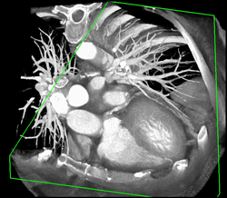 Diseased LAD and Left Main Coronary Artery - CTisus CT Scan