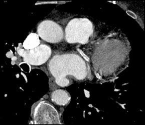 Significant Coronary Artery Disease - CTisus CT Scan