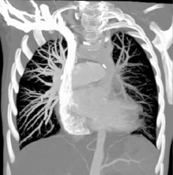 Decreased Pulmonary Artery Size on Left - CTisus CT Scan