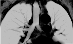 Stenosis in Left Mainstem Bronchus Due to Large Pulmonary AA - CTisus CT Scan