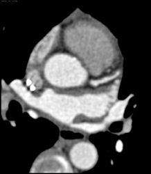 Soft Plaque in LAD - CTisus CT Scan