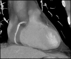 Calcified Plaque in RCA - CTisus CT Scan