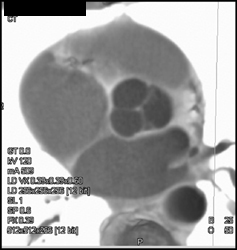 Thickened Aortic Cusps - CTisus CT Scan