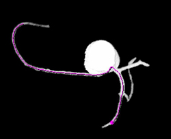 Aberrant Origin of RCA Off Left Main Coronary Arteries - CTisus CT Scan
