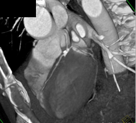 Plaque Without Occlusion LAD - CTisus CT Scan