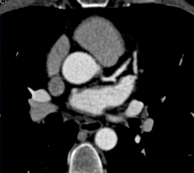 LAD Stent - CTisus CT Scan