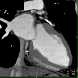 Plaque and Stenosis in LAD - CTisus CT Scan