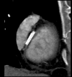 RCA Stent - CTisus CT Scan