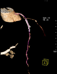 LAD Stent With LAD Stenosis - CTisus CT Scan