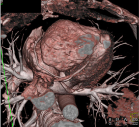 Normal RCA With Varying Display Formats - CTisus CT Scan