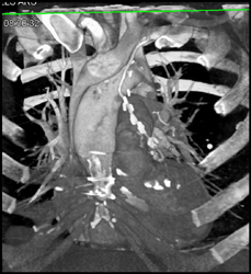 Patent Coronary Artery Bypass Graft (CABG) - CTisus CT Scan