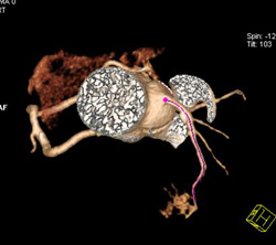 Plaque in LAD Without Stenosis - CTisus CT Scan