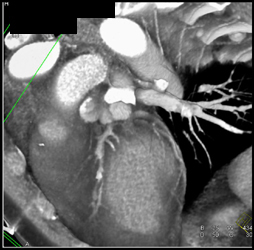 Diseased Cad - CTisus CT Scan