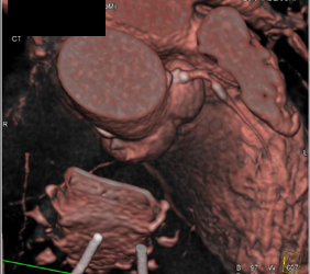 Plaque in LAD With VRT and Axial Display - CTisus CT Scan