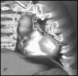 Left Internal Mammary Artery (LIMA) Graft - CTisus CT Scan