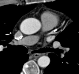 Dense Plaque in LAD With Stenosis - CTisus CT Scan