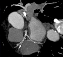 Multiple Plaque in LAD and Circumflex Artery (CX) - CTisus CT Scan
