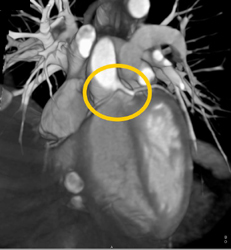 RCA Off Lt Cusp - CTisus CT Scan
