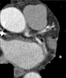 Soft Plaque and Calcified Plaque - CTisus CT Scan