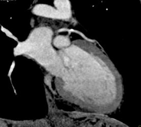 Focal Calcified Plaque in LAD - CTisus CT Scan