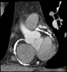 Extensive Calcified Plaque in RCA and LAD - CTisus CT Scan