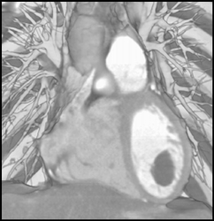 Benign Tumor in Left Ventricle-incidental Finding - CTisus CT Scan