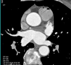 Air in Right Side of Heart-be Careful - CTisus CT Scan