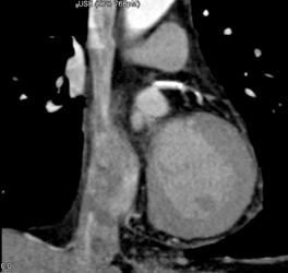 Less Than 50% LAD Stenosis - CTisus CT Scan