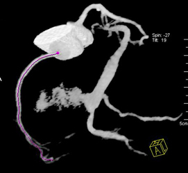 Nl RCA?? - CTisus CT Scan