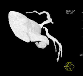 LAD Evaluation - CTisus CT Scan
