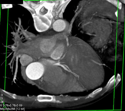 Trifurcation of RCA - CTisus CT Scan