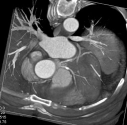 Circumflex of Lca Off Seperate Origins - CTisus CT Scan