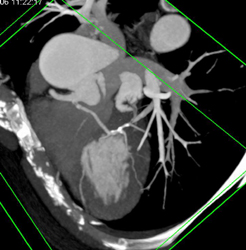 Left Main Arises Off Right Cusp - CTisus CT Scan