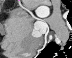 Anomalous RCA Off Lca - CTisus CT Scan
