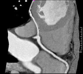 LAD Off RCA - CTisus CT Scan
