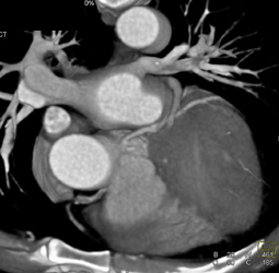 Circumflex and LAD Have Seperate Trunks - CTisus CT Scan