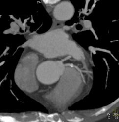 LAD and Circumflex Arises Directly From the Left Cusp - CTisus CT Scan